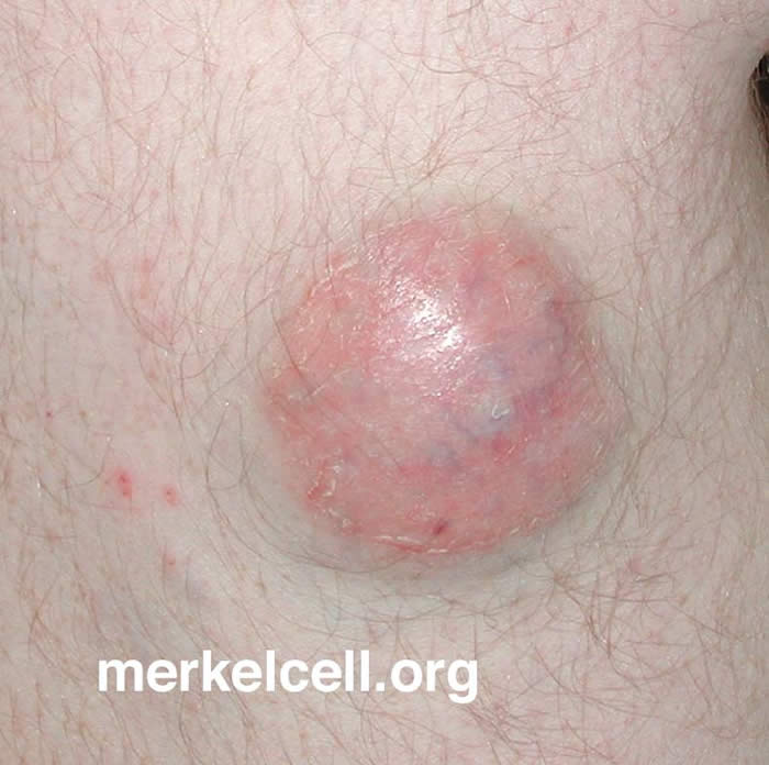 The Merkel Cell Mcc
