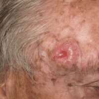 Clinical Photos of Merkel Cell Carcinoma | Merkel Cell Carcinoma