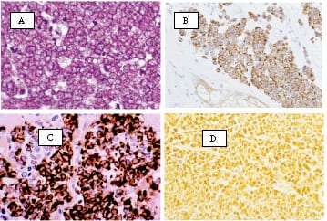 MCC as stained by A) hemotoxylin & eosin, B) CAM 5.2, C) CK 20, and D) NSE (Goessling, 2002 & Nghiem, 2001).