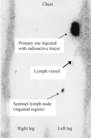 Mapping a sentinel lymph node. A radioactive tracer was injected at the site of a skin cancer on the left flank. The tracer traveled along the lymphatic vessels to a lymph node in the left groin and was then photographed using a special x-ray technique. This procedure allows the surgeon to identify the sentinel lymph node and remove it for pathologic analysis. Adapted from Perrott, 2003, with permission.