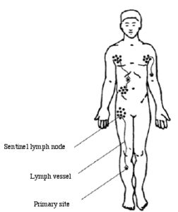 sentinel lymph node biopsy breast