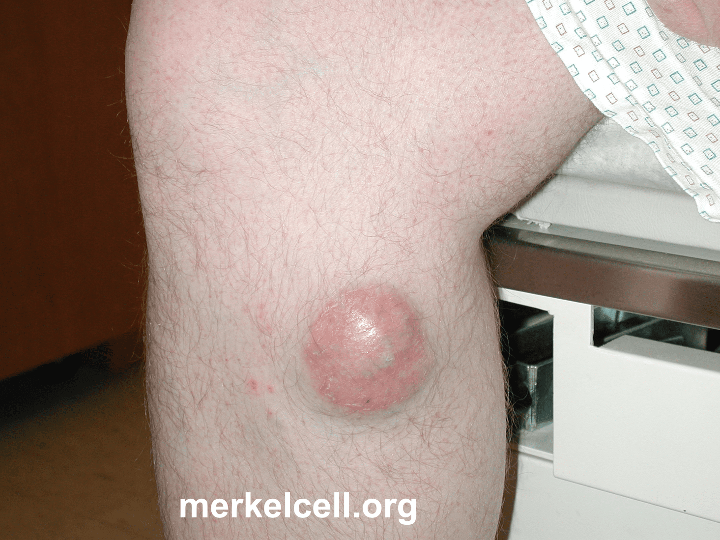 basal cell carcinoma early stages leg