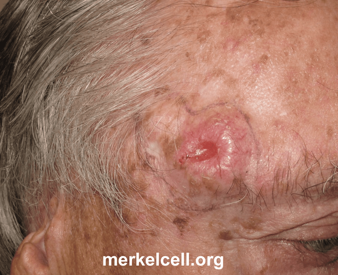 Clinical Photos Of Merkel Cell Carcinoma