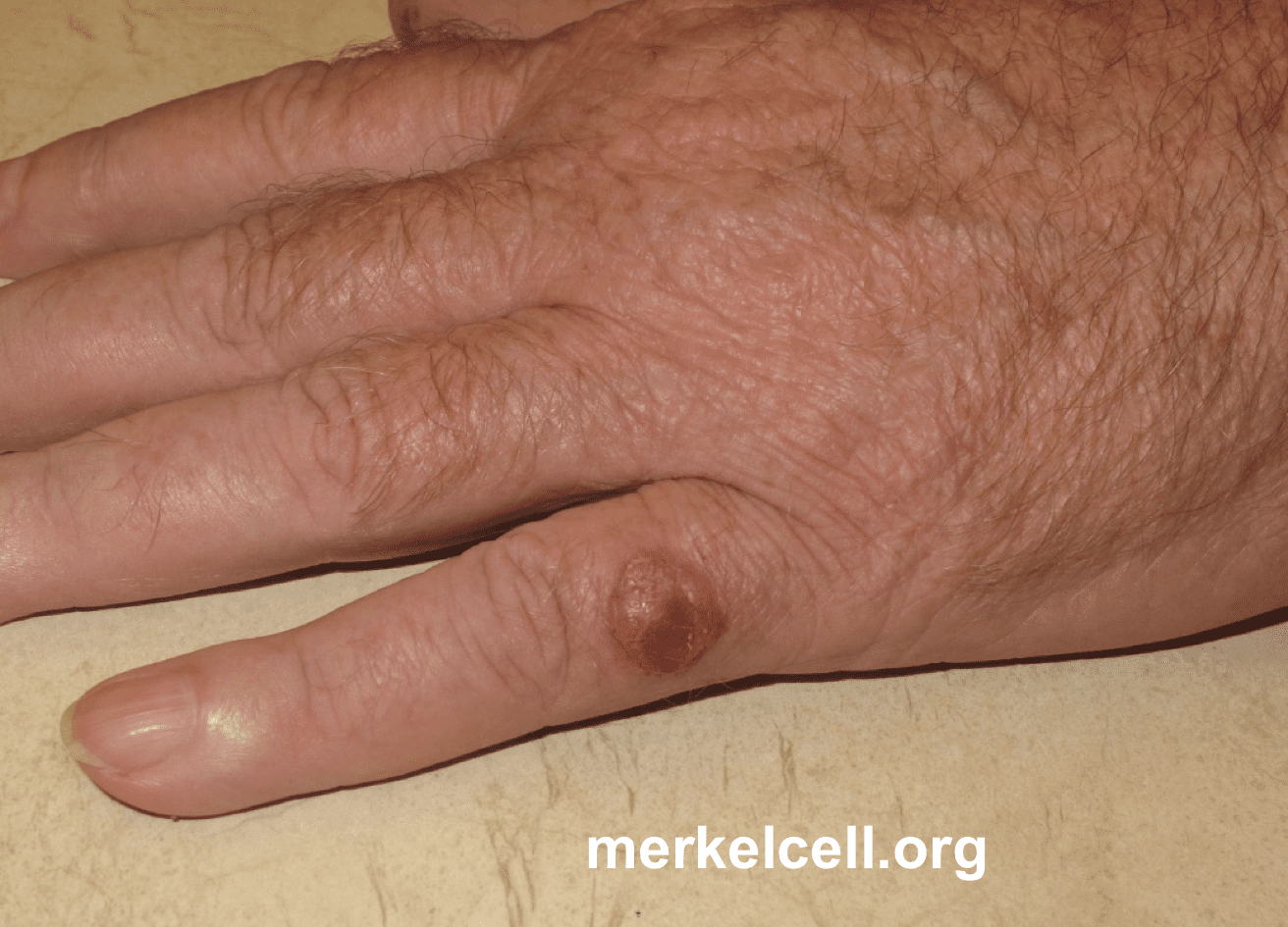 Picture of a Merkel cell carcinoma arising on the fifth digit of the left hand.